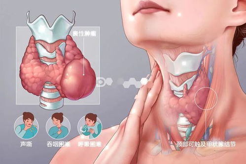 善疑难手术 精基础治疗 南阳医专一附院普通外科二病区 麻醉与围术期医学科手术部共同完成一例罕见巨大甲状腺肿瘤手术