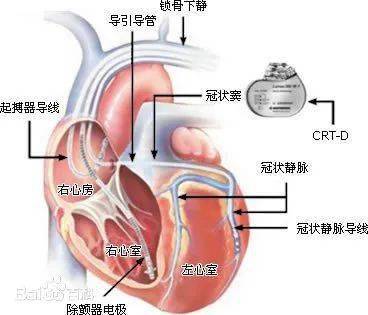 心脏起博器是否会造成心脏依赖而失去功能(心脏起搏器有依赖性吗)