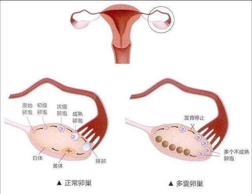 多囊和不孕之间的4个必知问题 关于月经 怀孕 治疗 试管......