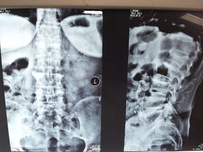 腰椎横突骨折图片 搜狗图片搜索