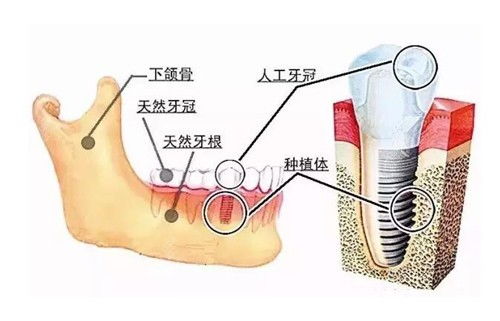 沈阳做种植牙正规的地方有哪些,要做全口种植价格低的牙科