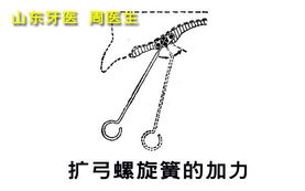 跟我认识螺旋扩弓器