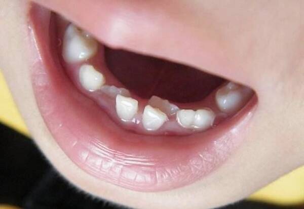 怎样可以预防小朋友牙齿不齐呢