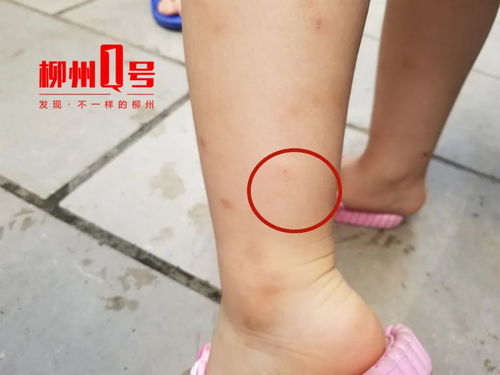 吓人 柳州4岁女童去幼儿园途中被未拴绳宠物狗袭击,腿部被抓伤