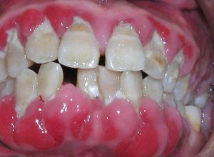 牙根外露图片 牙根外露症状图片 牙根外露图片大全 疾病百科 久久健康网 