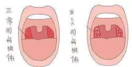 喉咙疼还发烧 孩子扁桃体为啥总发炎 要不要切