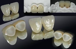 牙齿缺失想补牙是选择全瓷牙还是烤瓷牙比较好