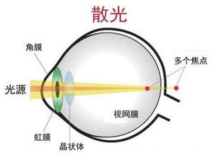 散光几度算正常范围(散光度数多少是正常的)