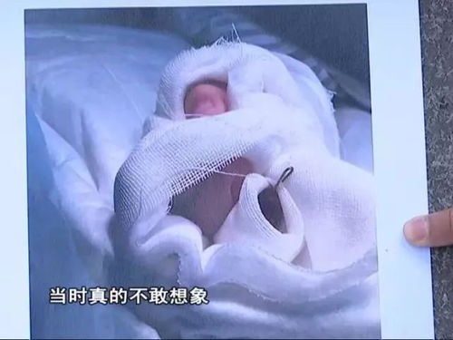 3岁男童被老师抱开几十秒一截手指没了 