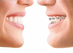 矫正牙齿能改变脸型 真的 关于牙齿矫正,你还需要知道这些 