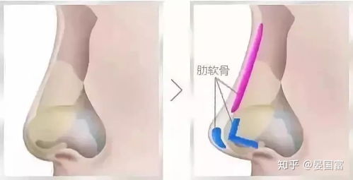 塌鼻梁 笑起来嘴歪怎么办 