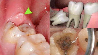 为什么医生一定要让你拔智齿 你不知道的真相 