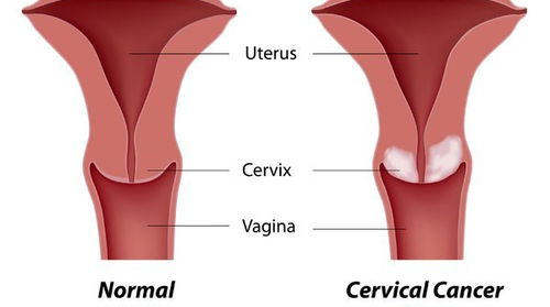 宫颈癌的早期症状早知道