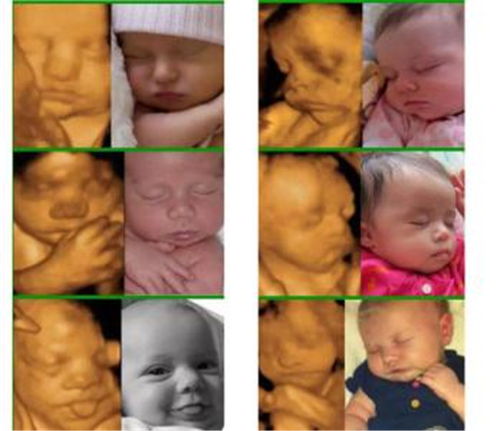 四维宝宝照 四维照片跟真婴儿对比一点也不像是怎么回事