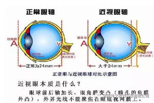 假性近视与真性近视的区别