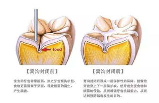 成人有必要进行 窝沟封闭 吗