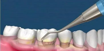 洗牙会震碎牙齿 一起看看那些洗牙误区