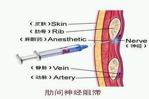 肋间神经痛 