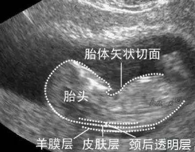 怀孕做的NT检查是检查什么呢 怀孕多少周去做检查合适