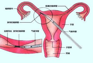 泰安做输卵管结扎复通术[山东红绘]精准复通