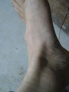脚上长个疙瘩,都一年多了,不疼不痒,手指按重了感觉有点像筋长起来的疙瘩,比较硬,抹活血化瘀的没效果 