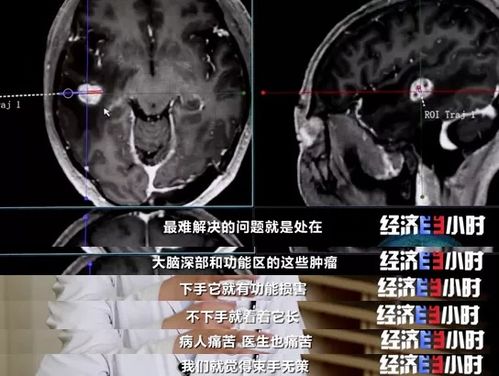 重大利好 费用预计为国外的5 不开颅治疗脑肿瘤 癌症患者的 生命之光 