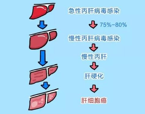 丙肝严重吗 该怎样保护肝脏