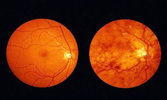 视网膜病变能治好吗 会不会致盲 听听舒安胶囊的回答