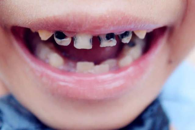 每 10个5岁孩子中,有 7 个孩子有蛀牙 引起龋齿的罪魁祸首是细菌
