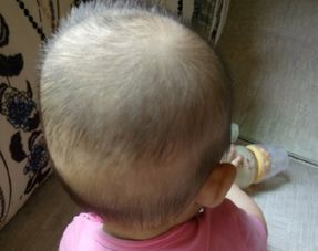 为什么有的宝宝出生就头发浓密,有的很稀疏 不完全由遗传决定