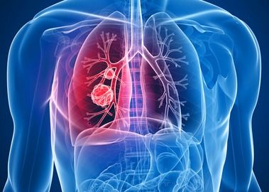 如何治好肺纤维化 