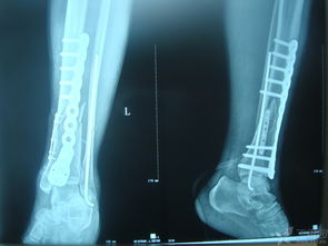 左脚腓骨远端骨折图片 图片欣赏中心 急不急图文 Jpjww Com