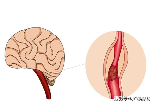 不沾烟酒,为什么脑梗还是找上门 脑梗来时,身体会有什么征兆