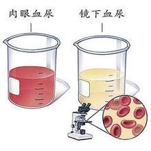 多数年轻女生尿路感染 尿血,只因冬季这个臭毛病