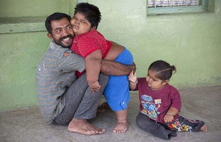 印度家庭三个超重孩子胖如相扑 父亲愿意卖肾筹钱治疗 