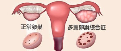 原创【医学小常识】多囊卵巢综合征患者如何高效避孕？（科普连载，不容错过！）