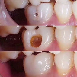 在进行龋齿修补时，为什么宁可将原牙磨掉也要将已腐蚀的部分除尽