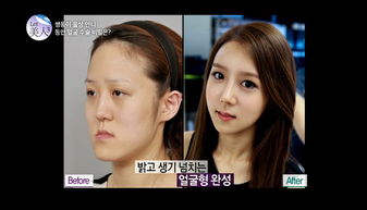 南韩戽斗双胞胎 扭转命运的整形 变出鹅蛋脸