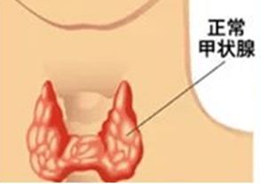 甲状腺结节穿刺是什么(甲状腺结节穿刺是什么手术)