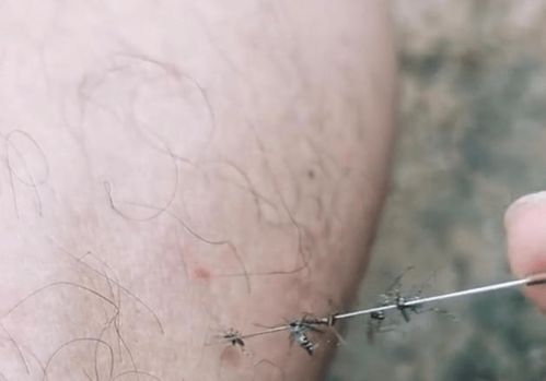 山东一男子被十多只蚊子咬急眼,拿起针对着腿上的蚊子猛刺戳成串