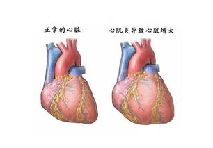 心肌炎等引起扩张型心肌病如何用药治疗