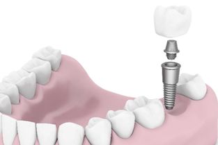 种植牙的利与弊外观与性能兼备的替代选择 合肥