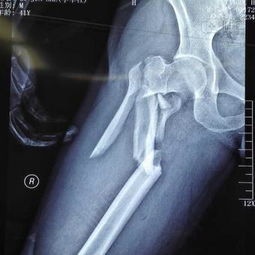 男,40岁,股骨上段和粗隆间粉碎性骨折如何治疗