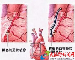 装上心脏支架, 生命步入倒计时