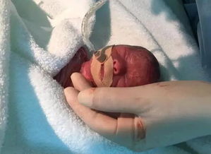 孕妈26周早产产下巴掌双胞胎,护理早产儿要面临五道关