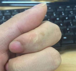 五个手指不同的疤痕 所代表的不同含义你知道吗
