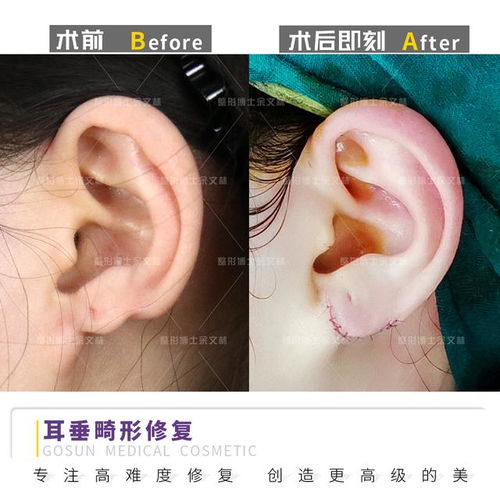 耳垂畸形修复术后耳朵会留疤吗