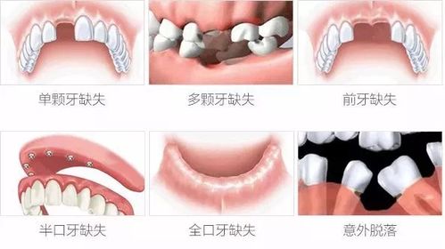 西安圣贝医生黄祎铭 缺牙患者的首选修复方式 种植牙
