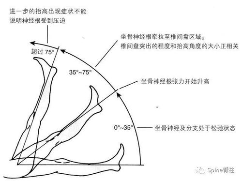 直腿抬高试验对腰椎间盘突出症有哪些影响