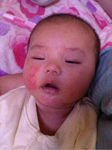 婴儿湿疹怎么治,婴儿湿疹是一种常见的皮肤病，通常